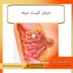 درمان کیست سینه