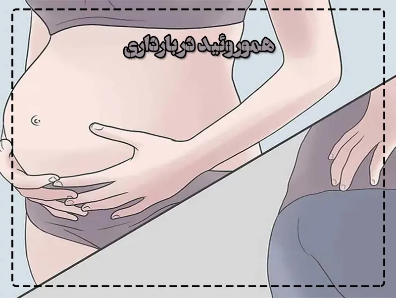 هموروئید در بارداری 