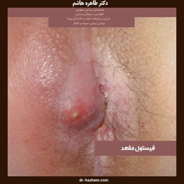 عکس فیستول
