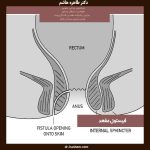 عکس فیستول مقعدی