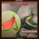 تغذیه بعد از جراحی کیسه صفرا