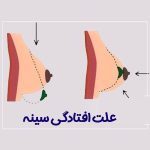 علت افتادگی سینه - دکتر طاهره هاشم