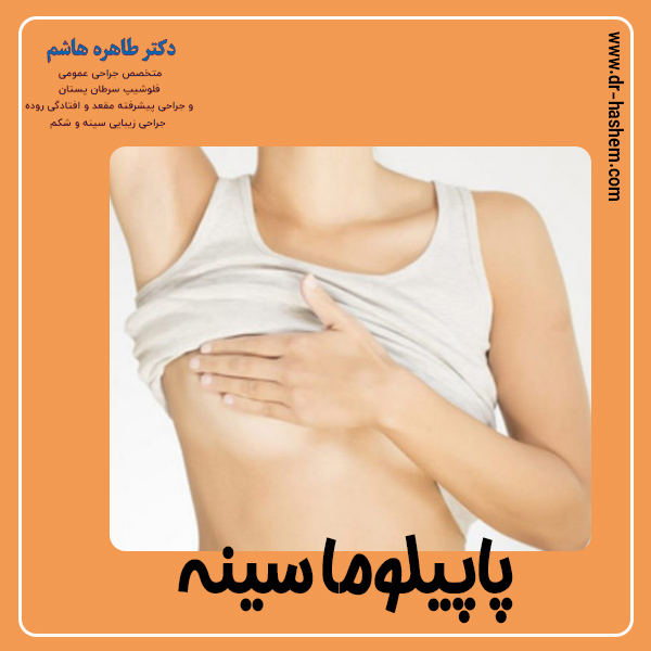 پاپيلوما سينه - دکتر طاهره هاشم