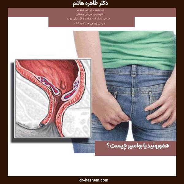 هموروئید یا بواسیر