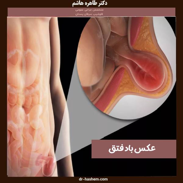 عکس باد فتق زنان