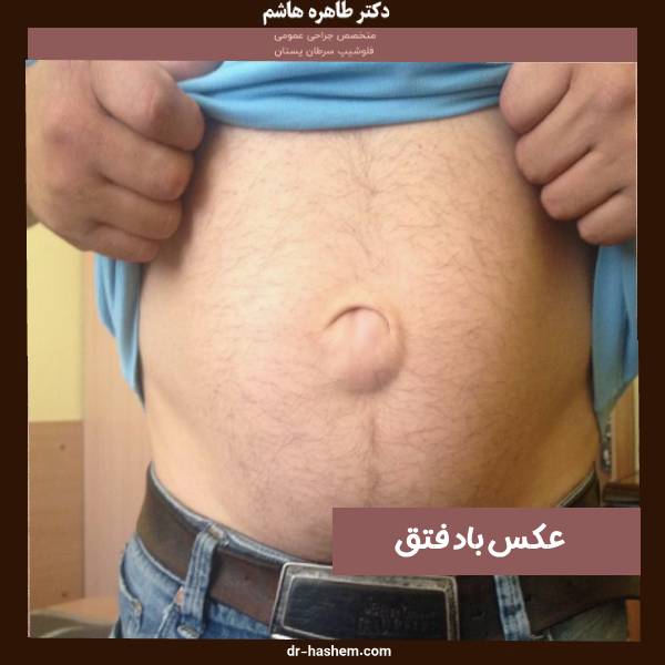 عکس فتق مردان