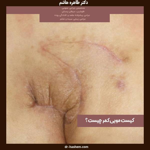 عکس کیست مویی درمان شده