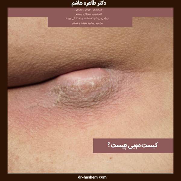 عکس کیست مویی باسن