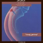 عکس کیست مویی