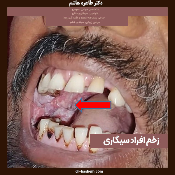 زخم افراد سیگاری