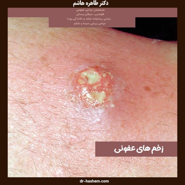 زخم های عفونی