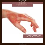 عکس زخم سوختگی