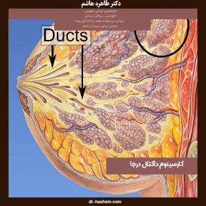 کارسینوم داکتال درجا- دکتر طاهره هاشم - dr-hashem.com