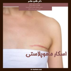 اسکار ماموپلاستی - دکتر طاهره هاشم - dr-hashem.com