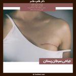 جراحی سرطان پستان
