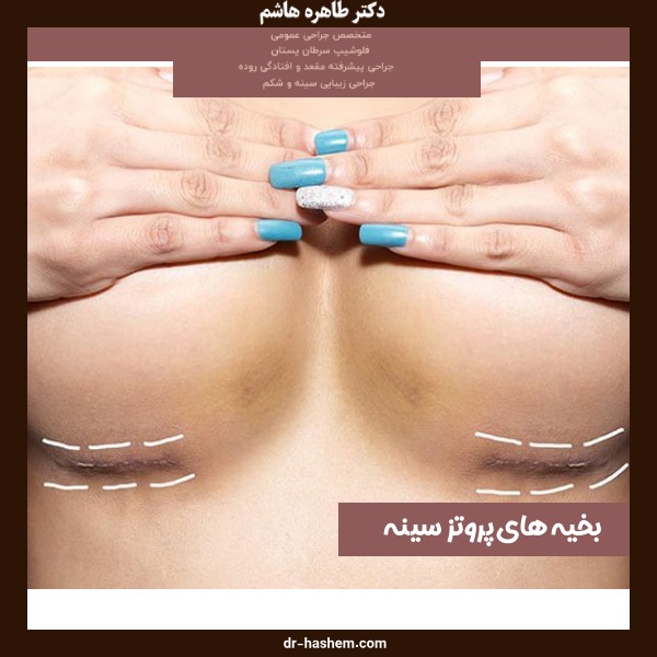 بخیه های پروتز سینه