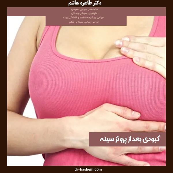 کبودی بعد از پروتز سینه
