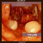 عکس پولیپ روده