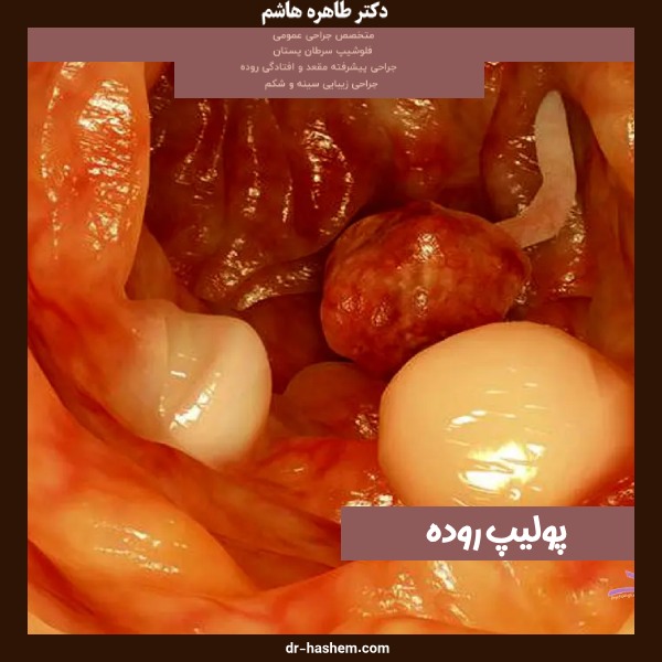 عکس پولیپ روده