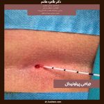 جراحی پیلونیدال