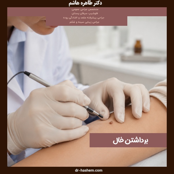 برداشتن خال