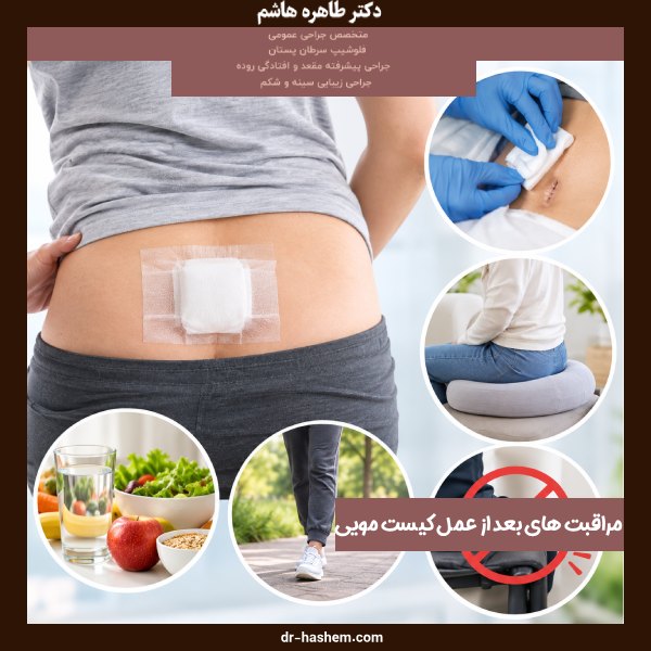 مراقبت های بعد از عمل کیست مویی