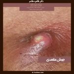 جوش مقعدی