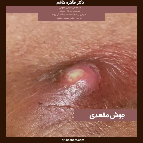 جوش مقعدی