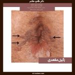 زگیل مقعدی