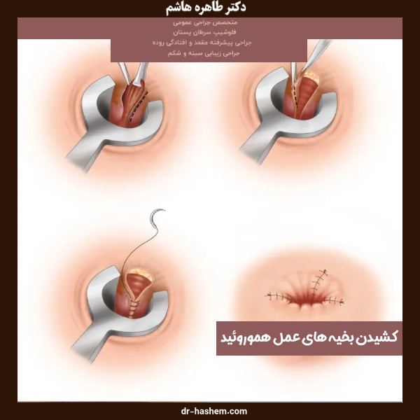 کشیدن بخیه های عمل هموروئید